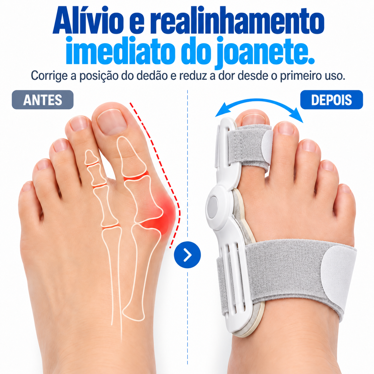 Alívio e realinhamento imediato do joanete — antes e depois